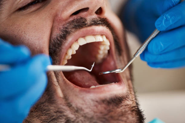 Emergency Dental Filling Replacement in WA